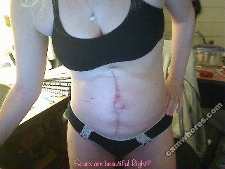 A 320x240 pixel webcam photo of Sunny Crittenden circa 2012 featuring the scars on Sunny's abdomen after major ventral hernia repair due to having bedside surgery at St. Mike's in Toronto to relieve compartment syndrome.